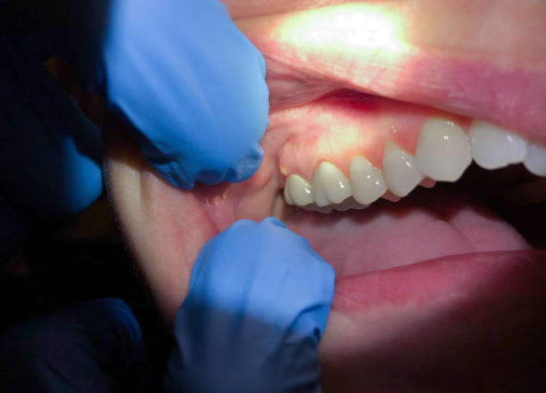 Best Emergency Dental Care for Sports Injuries in Milton, PA